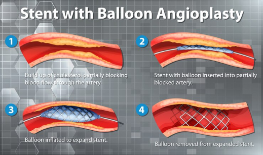 Understanding Coronary Angioplasty A Comprehensive Guide for Heart Health